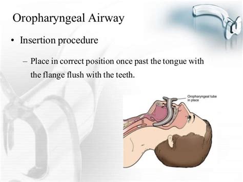 Oral Airway Presentation