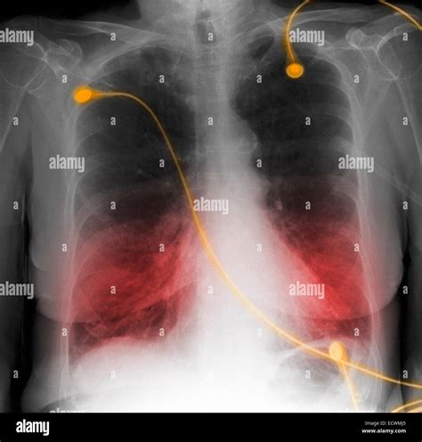 CXR showing COPD, chronic obstructive pulmonary disease Stock Photo - Alamy