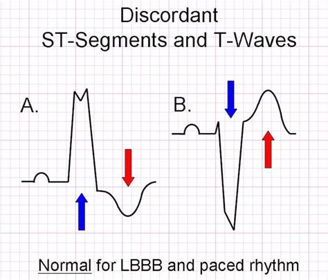 Sgarbossa Criteria • LITFL • ECG Library Diagnosis