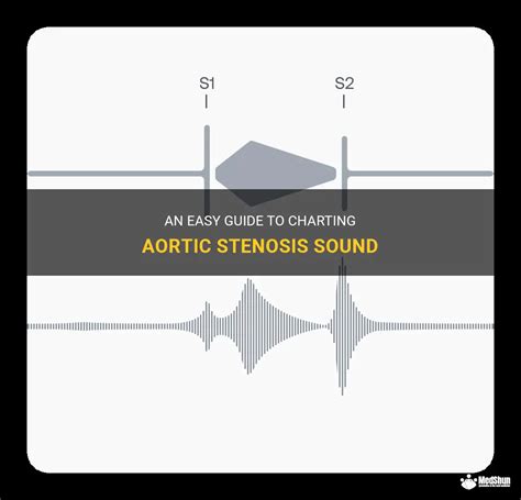 An Easy Guide To Charting Aortic Stenosis Sound | MedShun