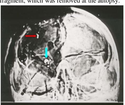 Figure 1 from THE JOHN F. KENNEDY AUTOPSY X-RAYS: THE SAGA OF THE ...