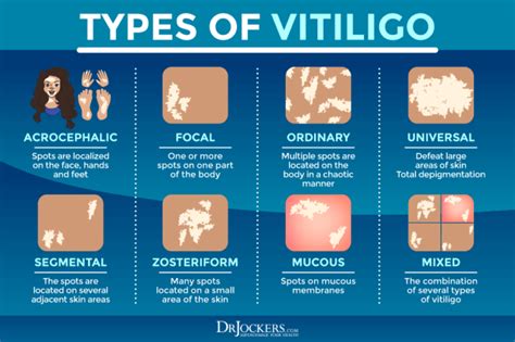 Vitiligo: Symptoms, Causes, and Support Strategies