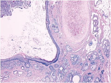 Branchial Cleft Cyst Histology