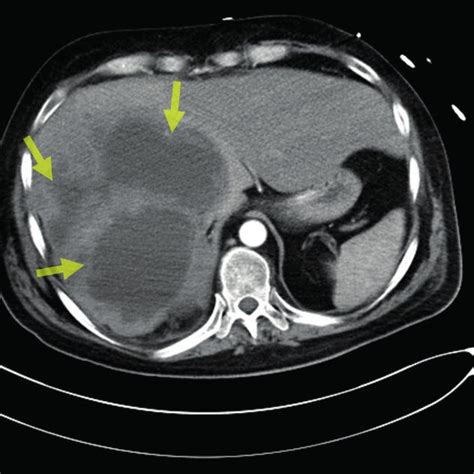 Multiple hepatic lesions. | Download Scientific Diagram