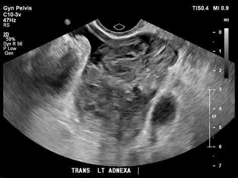 Ruptured Ectopic Pregnancy Ultrasound