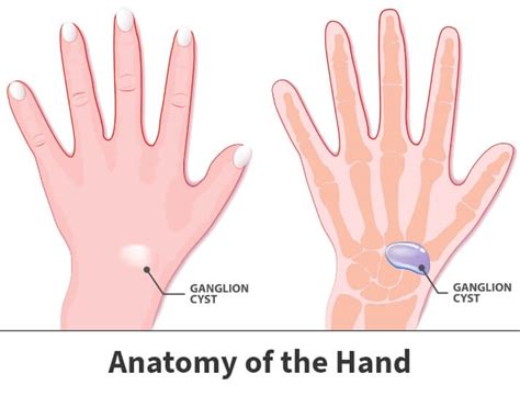 Ganglion Cyst Wrist