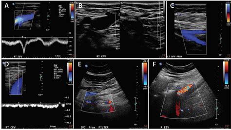 Diagnosis of Iliac Vein Obstruction With Duplex Ultrasound - Endovascular Today