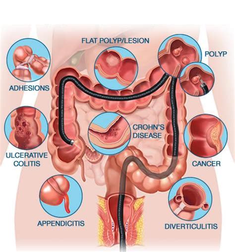 Colonoscopy - Definition, Purpose, Procedure, Results - Medicalook Tests