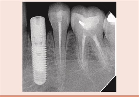 b: Radiograph of the immediate implant after placement. | Download ...