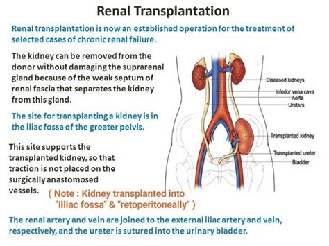 Renal / Kidney Transplantation ... #External #illiac #retroperitoneally ...