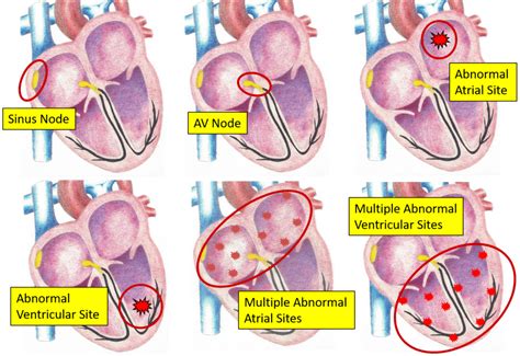 ACLS Rhythms Learn Terminology, Definitions, Pathophysiology