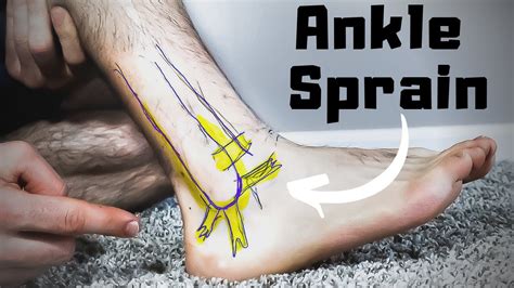 Sprained Foot Healing Time: How Long & How To Speed It Up