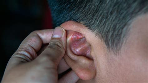 Ear Eczema: Symptoms, Causes, and Treatments