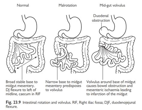 Paediatrics: Midgut malrotation and volvulus