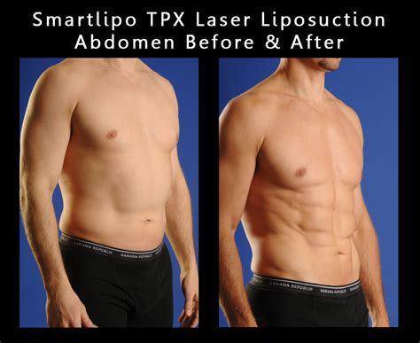 SmartLipo® Triplex - California Skin Institute