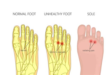 Morton's Neuroma | Foot Specialist Toronto | Feet First Clinic