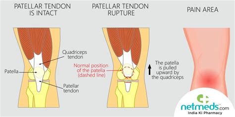 Jumper’s Knee: Causes, Symptoms and Treatment