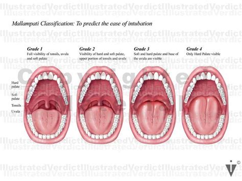 Stock Throat: Intubation / Tracheostomy — Illustrated Verdict