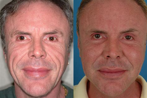 Sculptra Treatment Before & After Photos | Dr. Bassichis