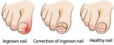 Nail Surgery - Bracing & Partial Nail Avulsion | Concord Podiatry