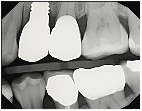 Ceramic Implants and Dental Implant Rehabilitation, Part I - Dentistry Today