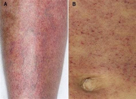 What causes low platelets? – What causes this?