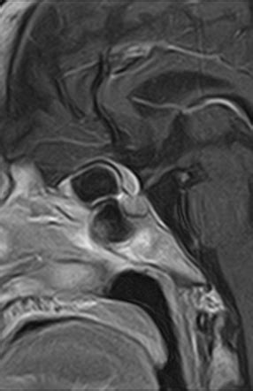 Planum sphenoidale meningioma | Radiology Case | Radiopaedia.org