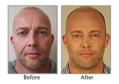 Mens Facelift Before And After