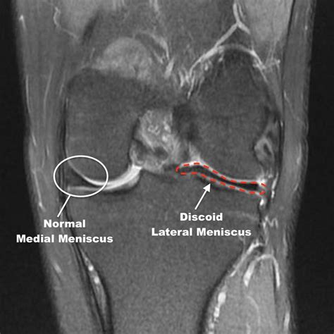 Discoid Meniscus: What to Look For?