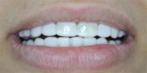 Press On Veneers Before and After - Photo Gallery – TruSmile Veneers