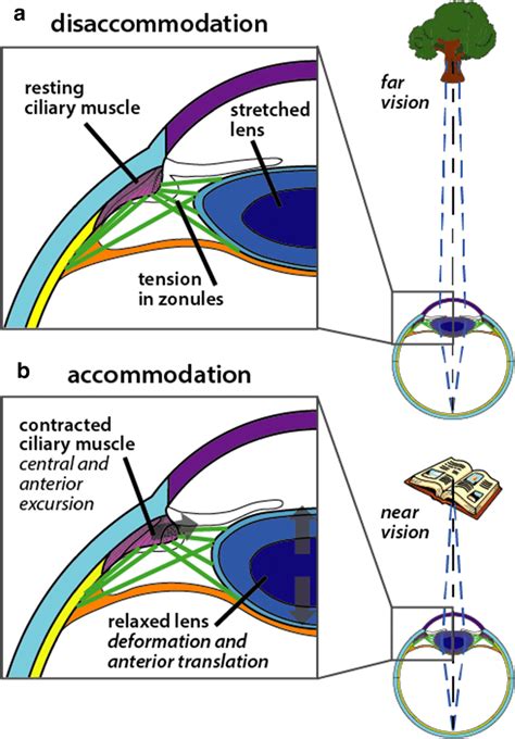 Diagram of accommodation.a In disaccommodation, the lens is stretched ...