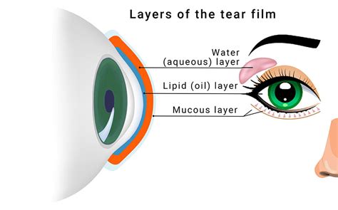 Dry eye syndrome | Glossary | Lentiamo