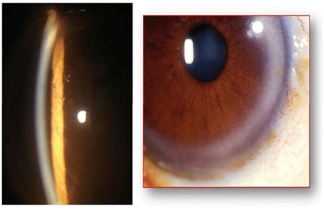 Showing Kayser -Fleischer ring in Descemet's membrane on Slit lamp and... | Download Scientific ...