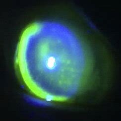 Peripheral Ulcerative Keratitis – (Rt) eye. | Download Scientific Diagram