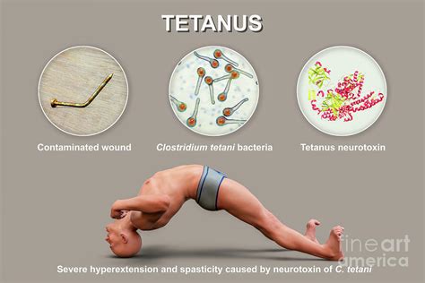 Mechanism Of Tetanus Disease #4 Photograph by Kateryna Kon/science ...