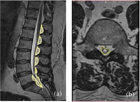 Minimal Approach to Spinal Epidural Lipomatosis Using the Japanese Step ...