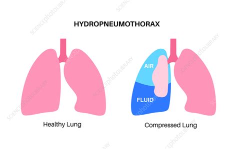 Hydropneumothorax, illustration - Stock Image - F041/5883 - Science Photo Library