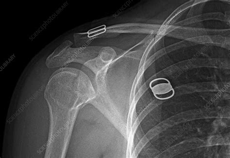 Humerus fracture, X-ray - Stock Image - F036/0235 - Science Photo Library