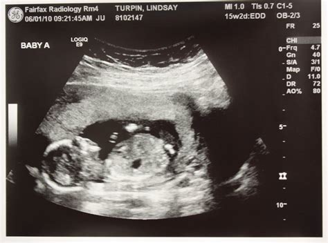 Adventures in Baby Making: 16 Weeks Ultrasound Pics