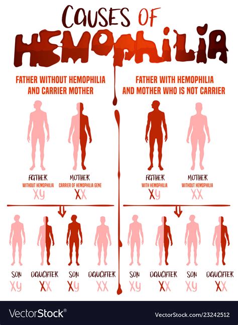 Hemophilia causes poster Royalty Free Vector Image