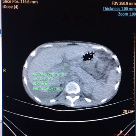 (PDF) Acute Pancreatitis with normal Amylase and Lipase Levels