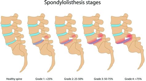 Spondylolysis and Isthmic Spondylolisthesis: A Guide to Diagnosis and Management | American ...