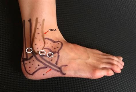 Subtalar Fusion (Arthroscopic) | Peter Rosenfeld FRCS, London