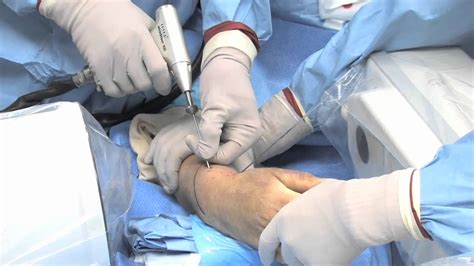 Broken wrist treated with the CPX by A.M. Surgical - YouTube