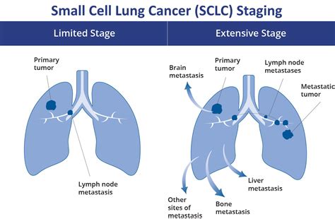 Stages Of Lung Cancer