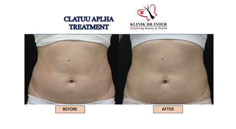 Fat Freezing Treatment - Freezes Fat Cells - Non-Surgical Treatment