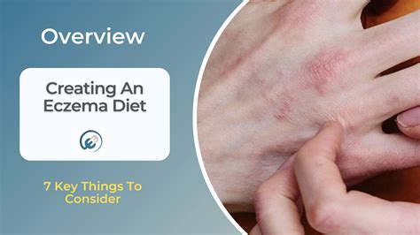 Creating An Eczema Diet: 7 Key Tips — Eating Enlightenment