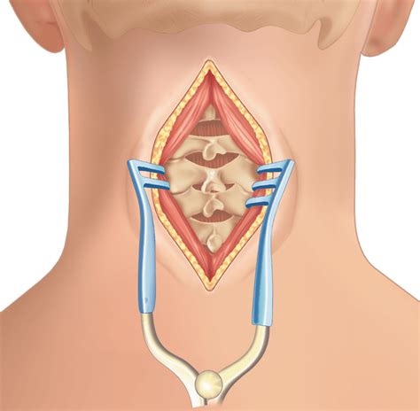 Posterior Cervical Fusion Procedure | Globus Medical