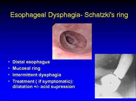 Esophagus Rita Brun MD Gastroenterology Department Rambam Health