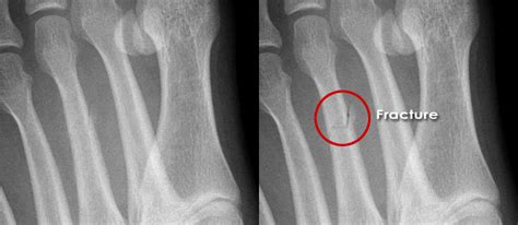 Xray Of Foot Stress Fracture